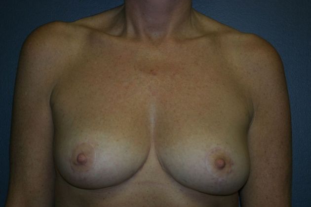 Breast Lift: Case 2 - After