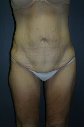 Tummy Tuck: Case 4 - Before