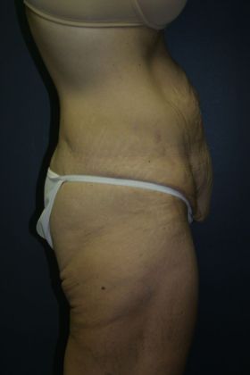 Tummy Tuck: Case 4 - Before
