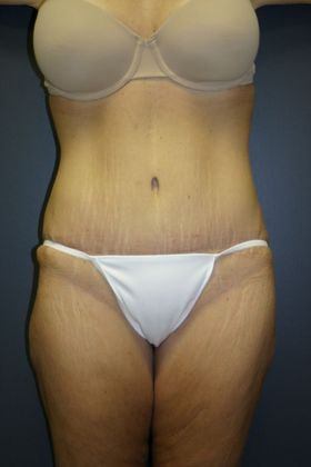 Tummy Tuck: Case 4 - After