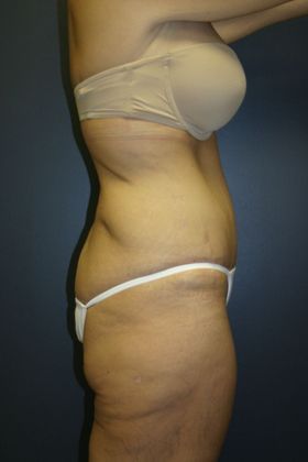Tummy Tuck: Case 4 - After