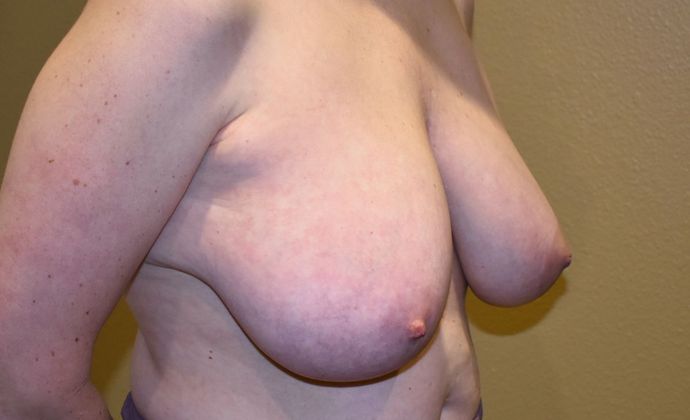 Breast Lift (Mastopexy): Case 75 - Before