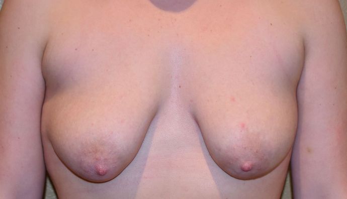 Breast Augmentation w/ Lift Case 281 - Before
