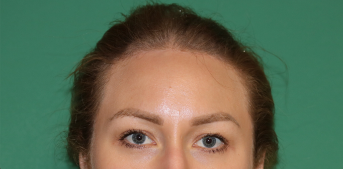 Hairline Lowering Surgery: Case 14 - After