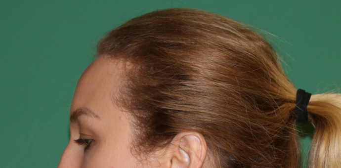 Hairline Lowering Surgery: Case 14 - After