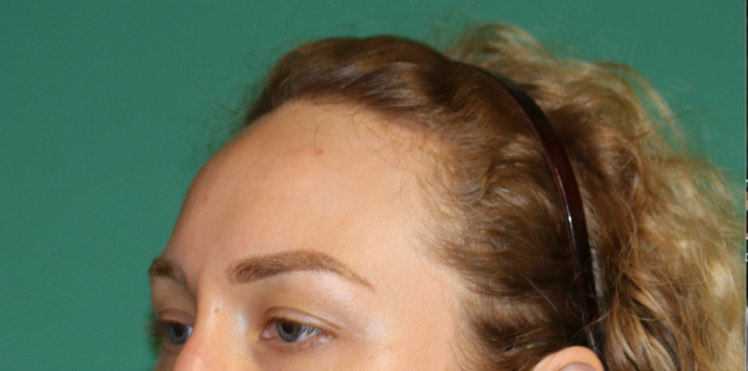 Hairline Lowering Surgery Case 14 - Before