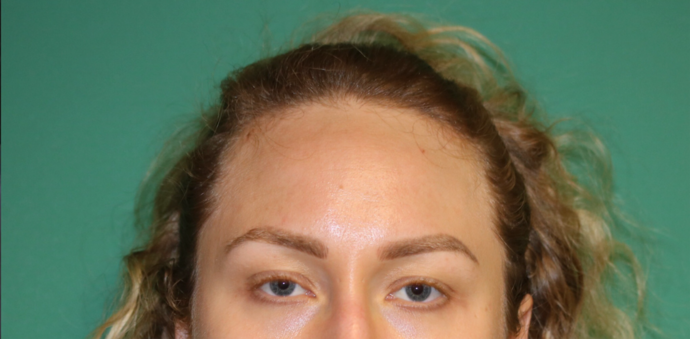 Hairline Lowering Surgery: Case 14 - Before