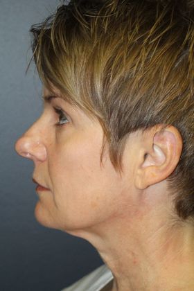 Facelift: Case 4 - Before