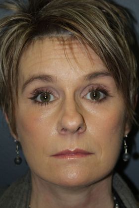 Facelift: Case 4 - After