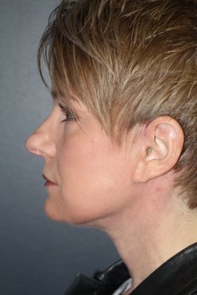 Facelift: Case 4 - After