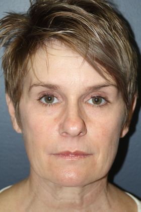 Facelift: Case 4 - Before