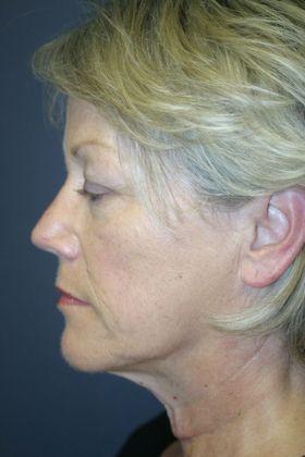 Facelift: Case 5 - Before