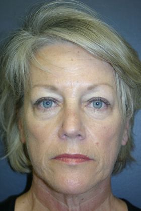 Facelift: Case 5 - Before