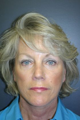 Facelift: Case 5 - After