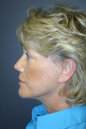 Facelift: Case 5 - After