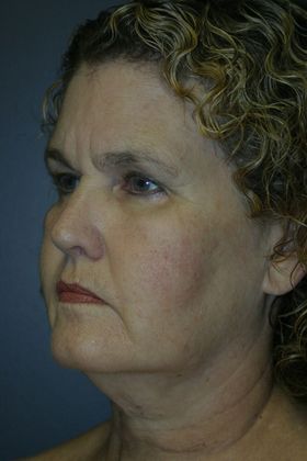 Facelift: Case 6 - Before