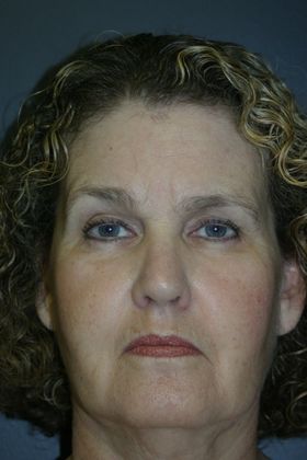 Facelift: Case 6 - Before