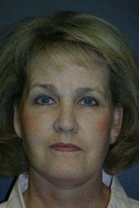 Facelift: Case 6 - After