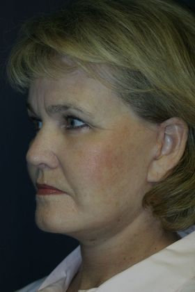 Facelift: Case 6 - After