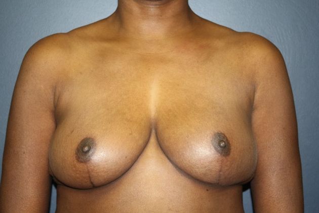 Breast Reduction Case 1 - After