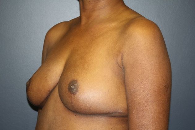 Breast Reduction: Case 1 - After
