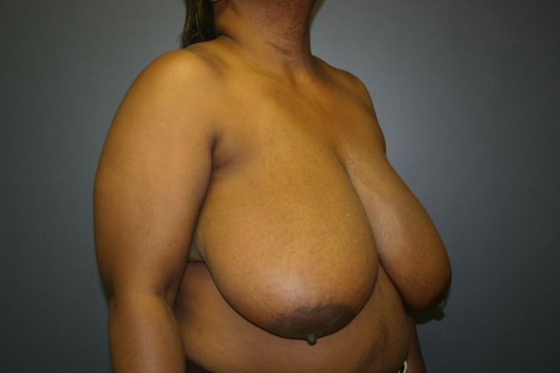 Breast Reduction: Case 3 - Before
