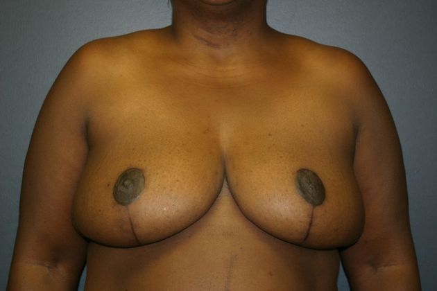 Breast Reduction Case 3 - After