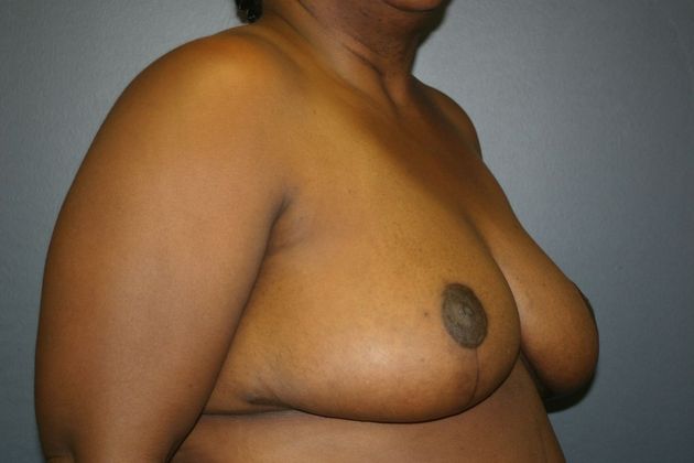 Breast Reduction: Case 3 - After
