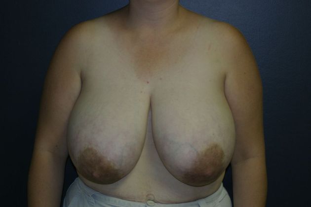 Breast Reduction Case 4 - Before