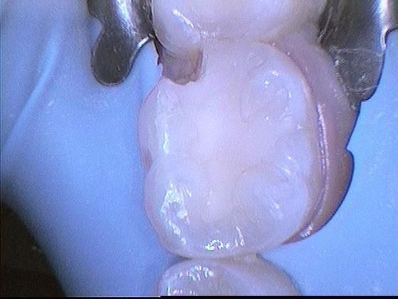 White Fillings: Case 6 Chipped Tooth - Before