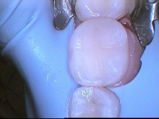 White Fillings: Case 6 Chipped Tooth - After