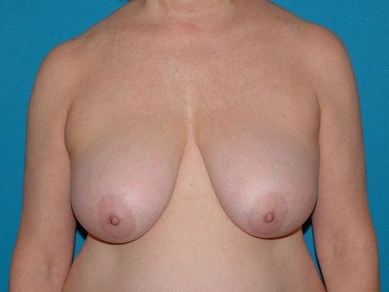 Mastopexy Case 3 - Carmel - Before