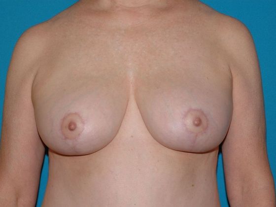 Mastopexy Case 3 - Carmel - After