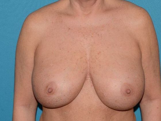 Mastopexy Case 4 - Avon - Before
