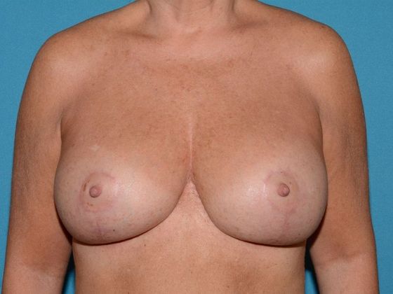 Mastopexy Case 4 - Avon - After