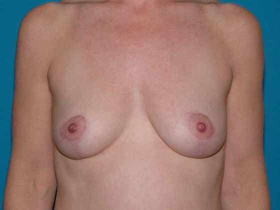 Mastopexy Case 5 - Fort Wayne - After