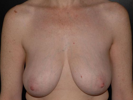 Mastopexy Case 6 - Terre Haute - Before