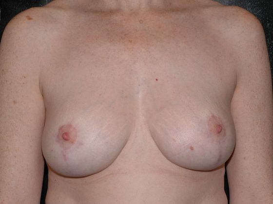 Mastopexy Case 6 - Terre Haute - After