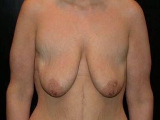 Breast Augmentation with Mastopexy Case 1 - Indianapolis - Before