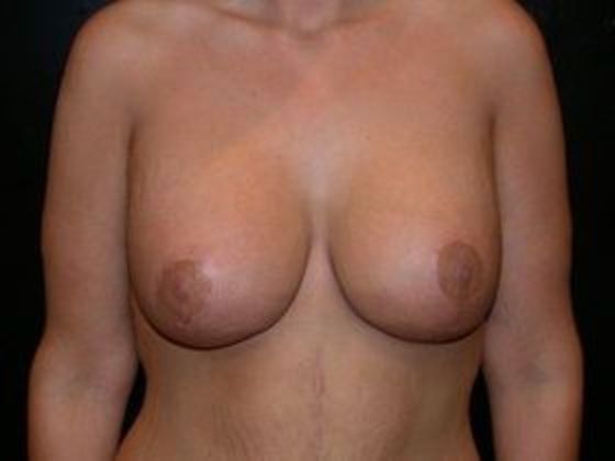 Breast Augmentation with Mastopexy Case 1 - Indianapolis - After