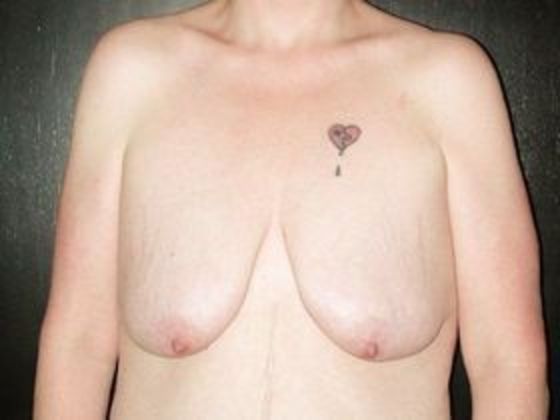 Breast Augmentation with Mastopexy Case 2 - Terre Haute - Before