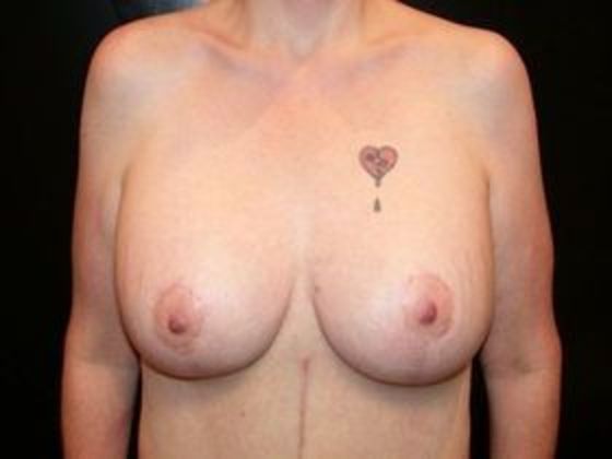 Breast Augmentation with Mastopexy Case 2 - Terre Haute - After