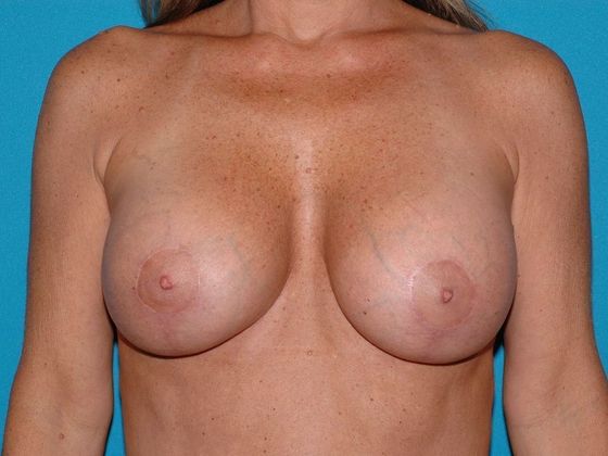 Breast Augmentation with Mastopexy Case 3 - Carmel - After