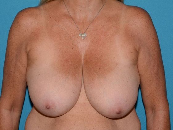 Breast Reduction Case 13 - Fort Wayne - Before