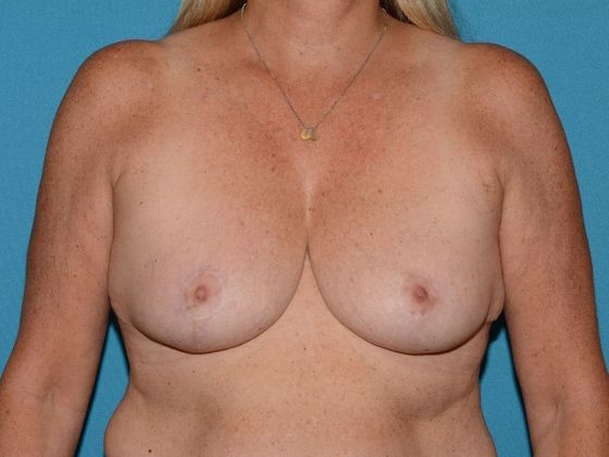 Breast Reduction Case 13 - Fort Wayne - After