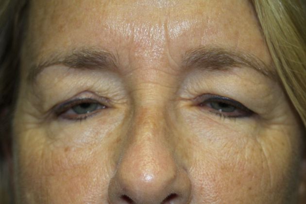 Blepharoplasty: Case 3 - After