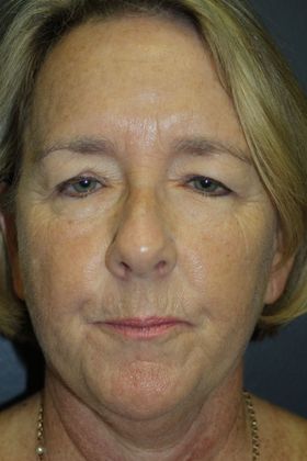 Blepharoplasty: Case 3 - Before