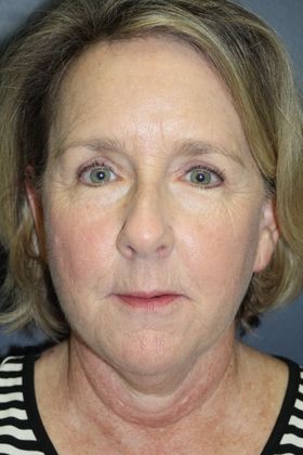 Blepharoplasty: Case 3 - Before