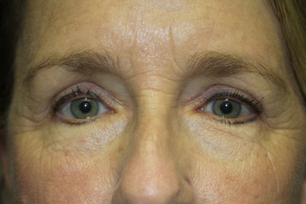 Blepharoplasty: Case 3 - After