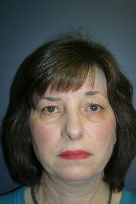 Blepharoplasty: Case 5 - Before